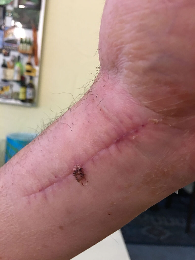 A view of Paul GJENVICKs Left Wrist.